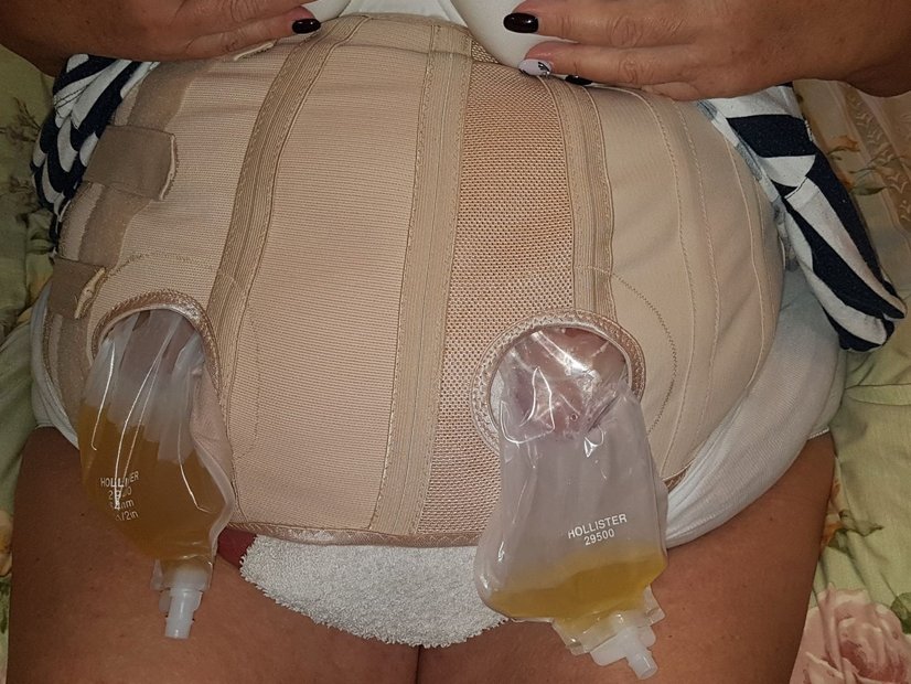 Bauchwunde mit Stomaanlagen – Zusätzliche Fixierung mit speziellem Mieder