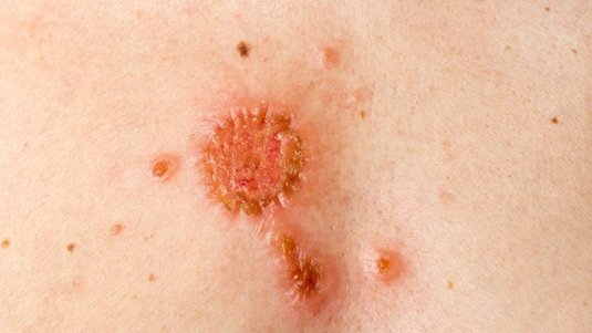 Achtung Hautkrebs – Warum das Screening so wichtig ist