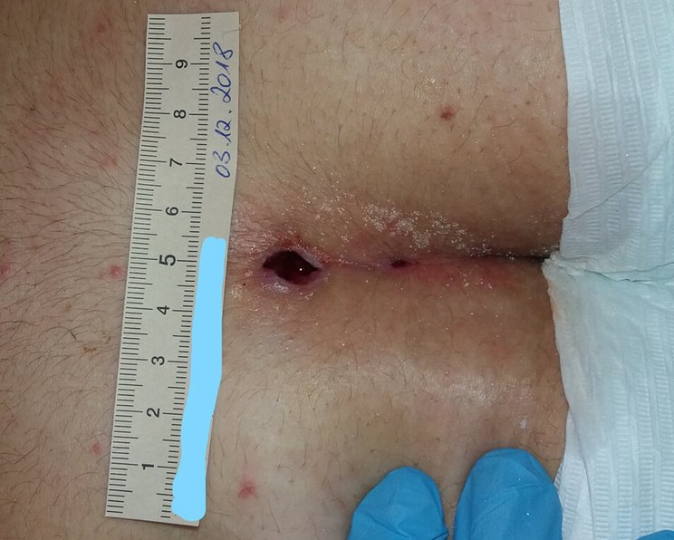 Sinus pilonidalis, Pilonidalsinus