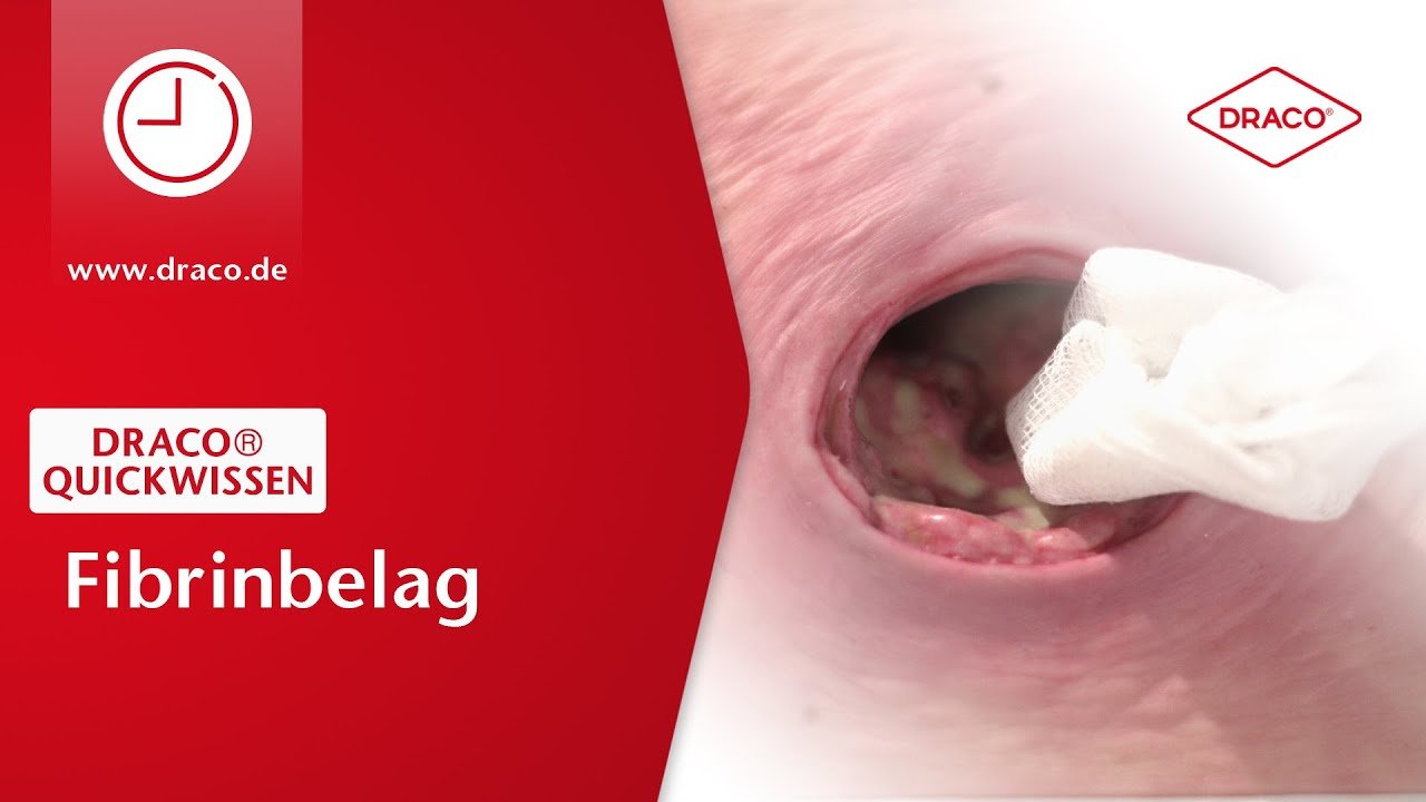 Video: Fibrin, Fibrinbildung auf Wunden, Entfernung und Behandlung von Fibrinbelag | Die Reihe 'Quickwissen' in den DRACO Experten-News