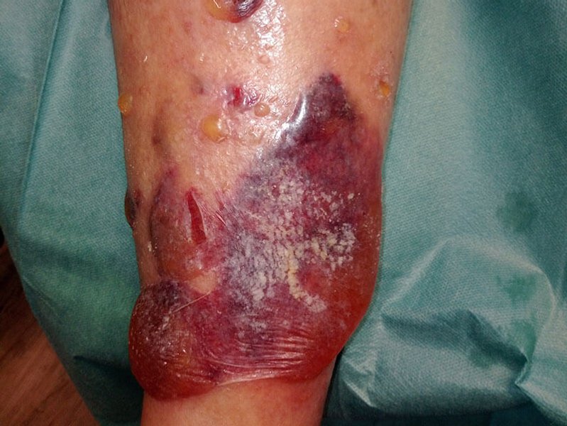 Ulcus cruris venosum nach Trauma