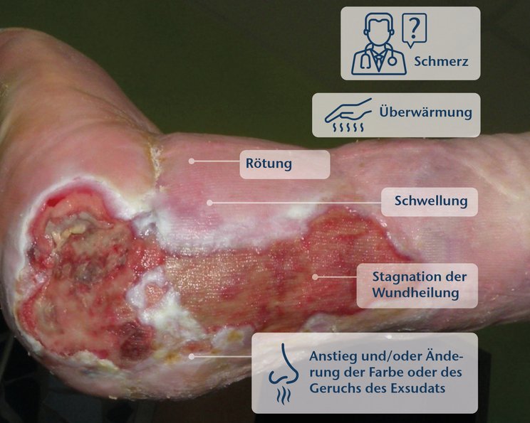 TILI-Score 2.0 - Therapeutischer Index für Lokale Infektionen