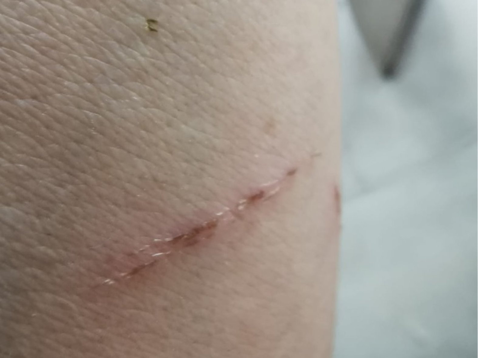 Verschorfte, leichte Kratzwunde