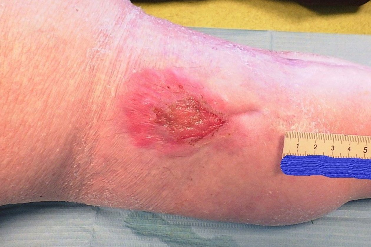 Ulcus cruris venosum, Vorher-Bild