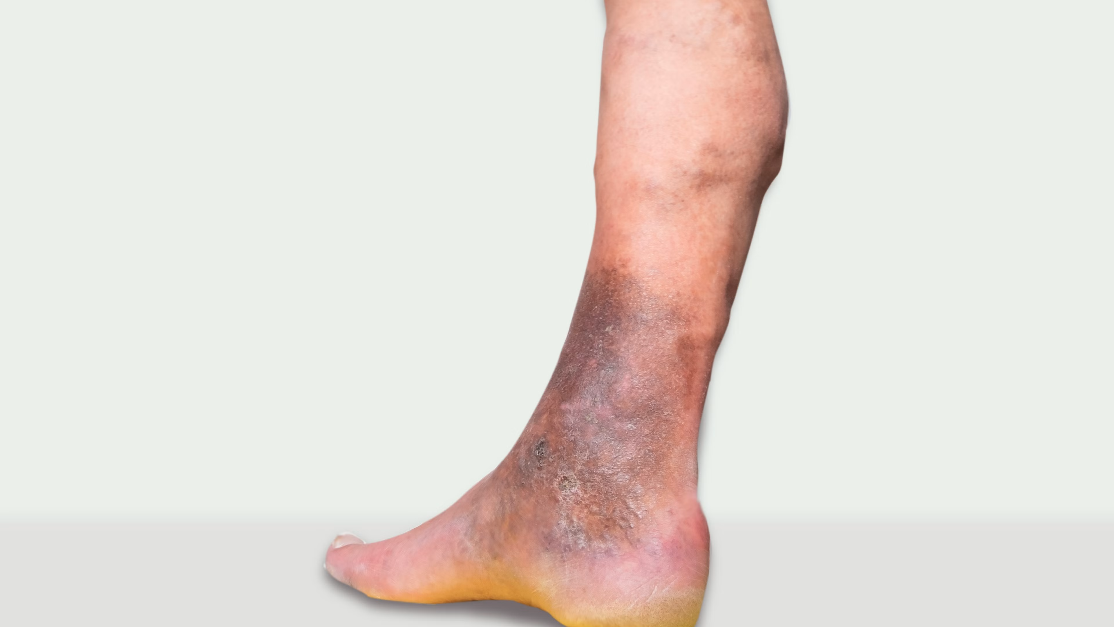 Kurz und kompakt: Dermatoliposklerose
