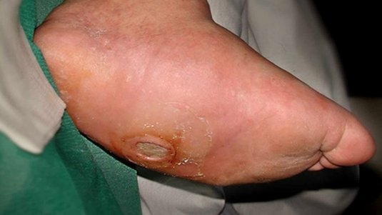 Kurz und kompakt: Charcot-Fuß erkennen