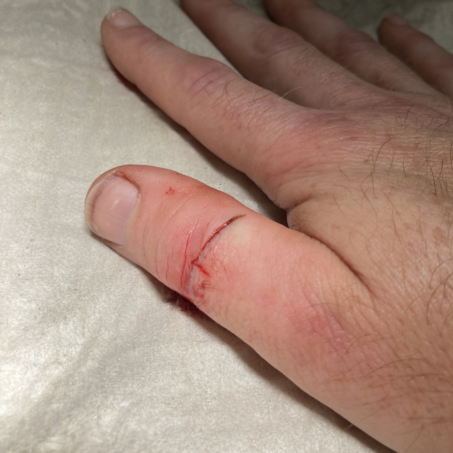 Foto 2: Wunde nach erster Wundreinigung durch den Patienten