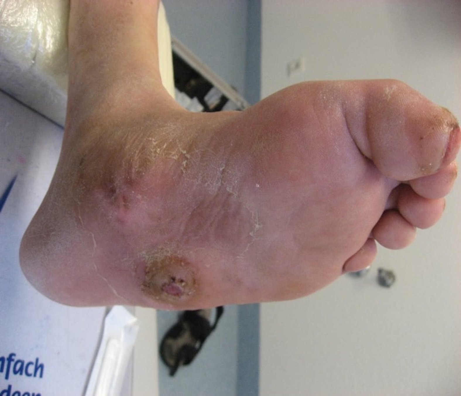 Charcot-Fußs-Ulcus mit Zehendeformation und Wunde