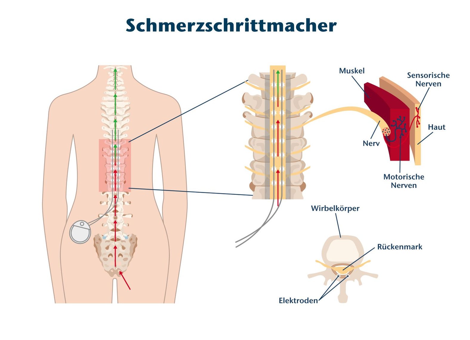 Schmerzschrittmacher: schematische Darstellung der Funktion
