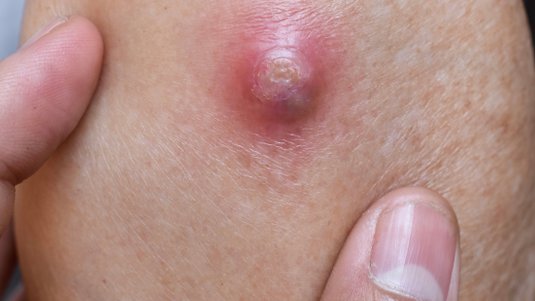 Mehr als nur ein Pickel: Abszesse, Furunkel und Karbunkel