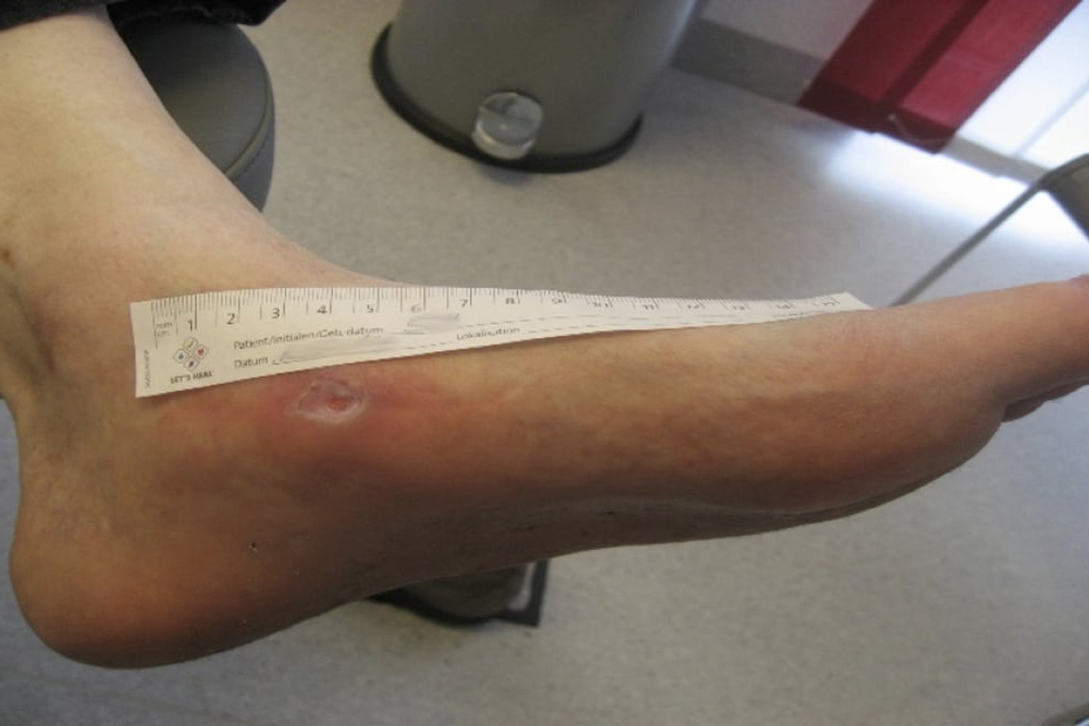 Plattfuß mit Charcot-Arthropathie