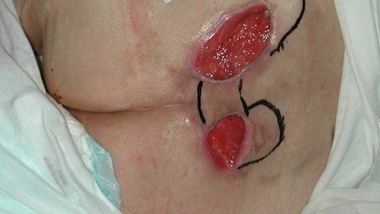 Fallbeispiel: Sakraldekubitus der Kategorie 4