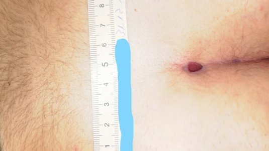 Fallbeispiel: Operative Abszesssanierung nach Steißbeinfistel (Sinus pilonidalis)