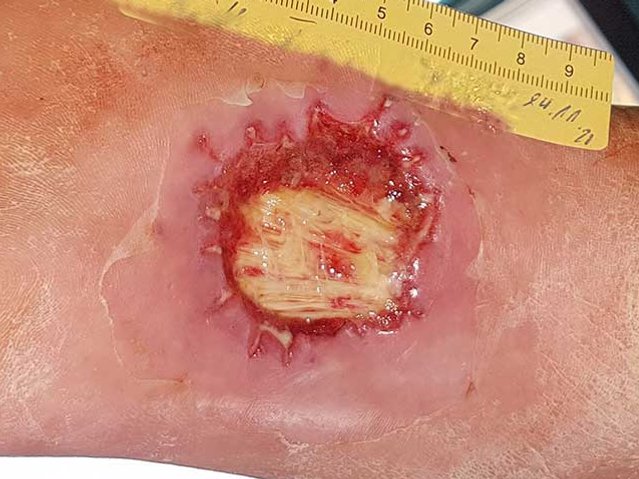 Diabetisches Fußsyndrom