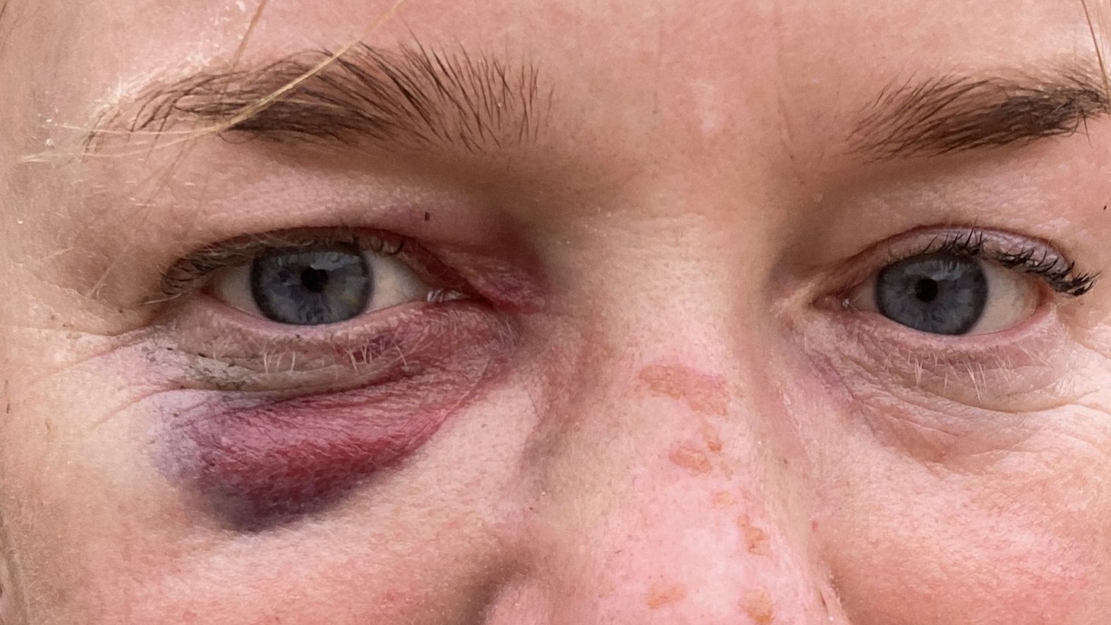 Quetschwunde, Einblutung am Auge, Tag 2