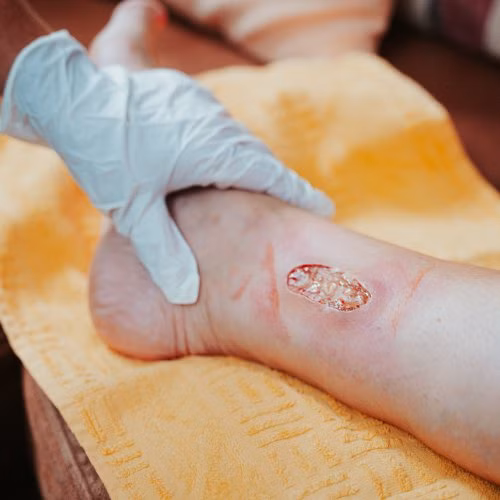 NEU: Ulcus cruris venosum erkennen und versorgen