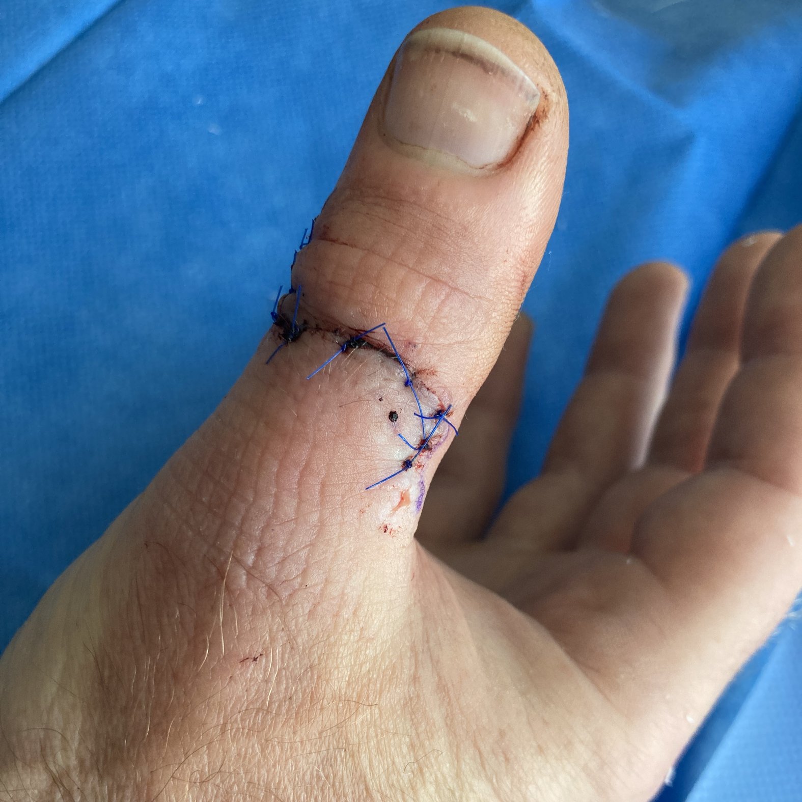 Foto 4: Die genähte Wunde am Tag nach der OP