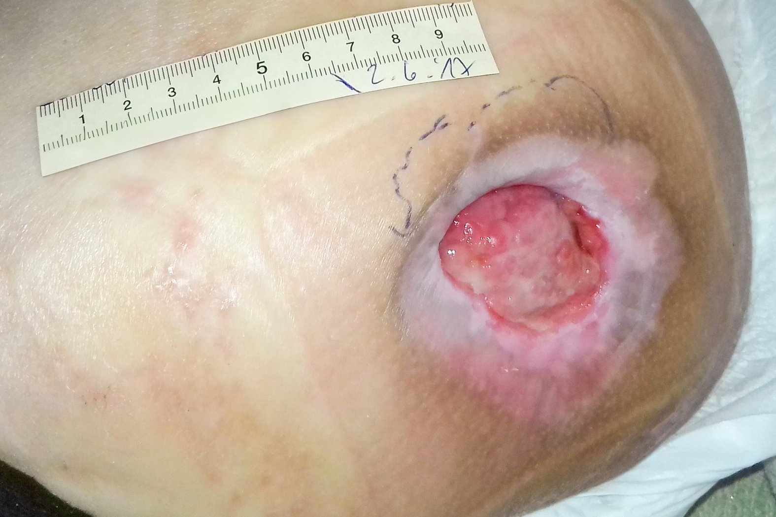 Fallbeispiel: Dekubitus Trochanter am ersten Tag