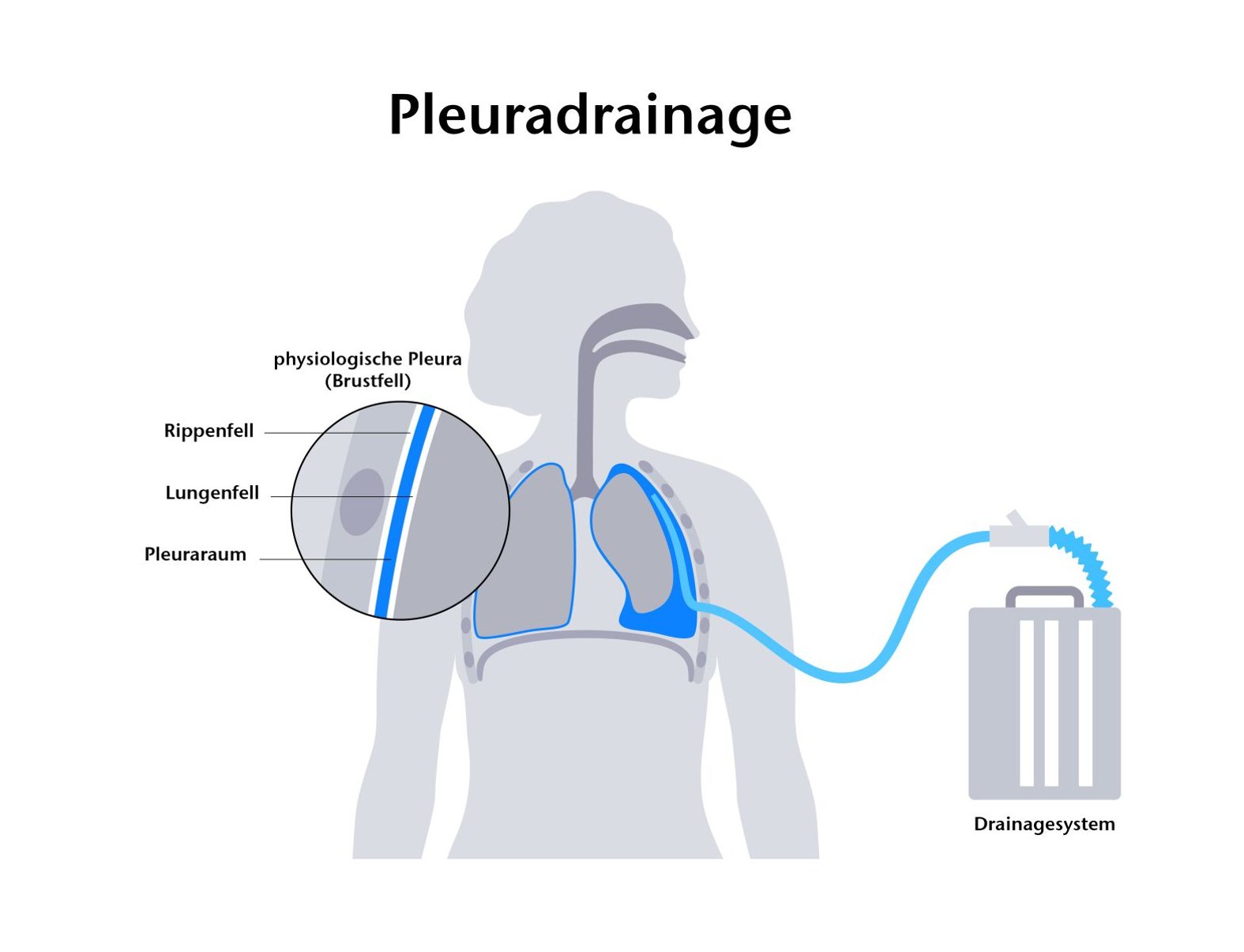 Pleuradrainage, schematische Darstelliung