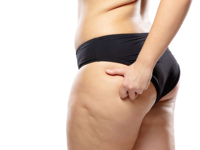 Lipödem, Lipidödem am Oberschenkel