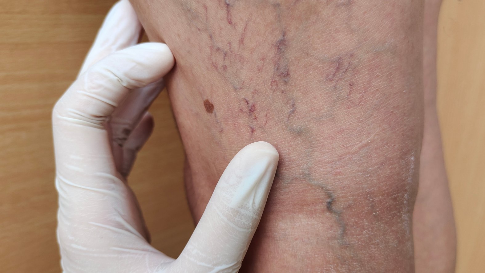 Varizen - Besenreiser am Oberschenkel