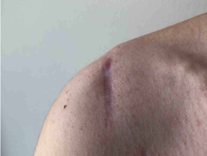 Abgeheilte OP-Wunde mit zurückgebliebener Narbe