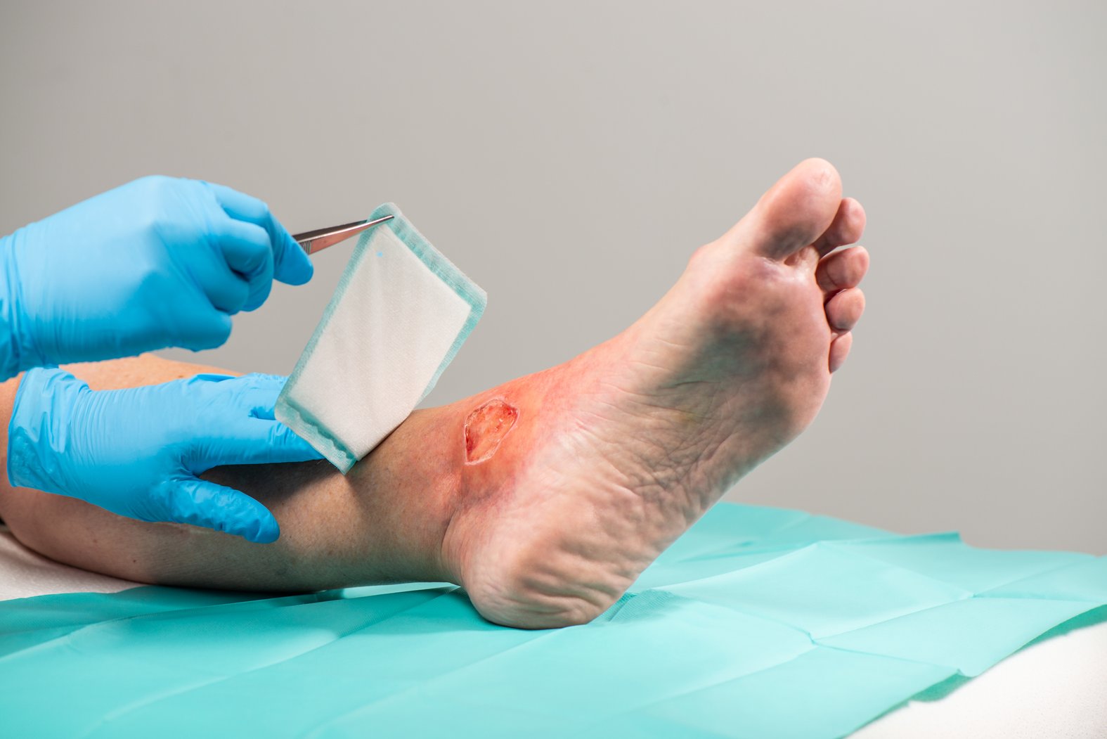 Draco Superabsorber, superabsorbierende Wundauflage, Anwendung