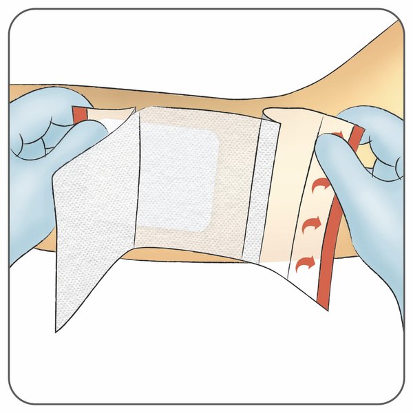 Fixiermull Stretch Anwendung: Anbringen, Schritt 4