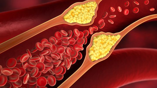 Update – Leitlinie Lokaltherapie pAVK und die Bedeutung für die Wundversorgung