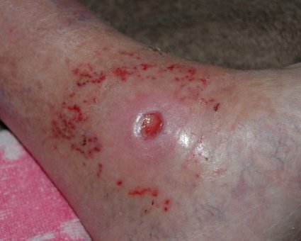 Pflasterallergie: Toxische Reaktion auf medizinischen Haftkleber