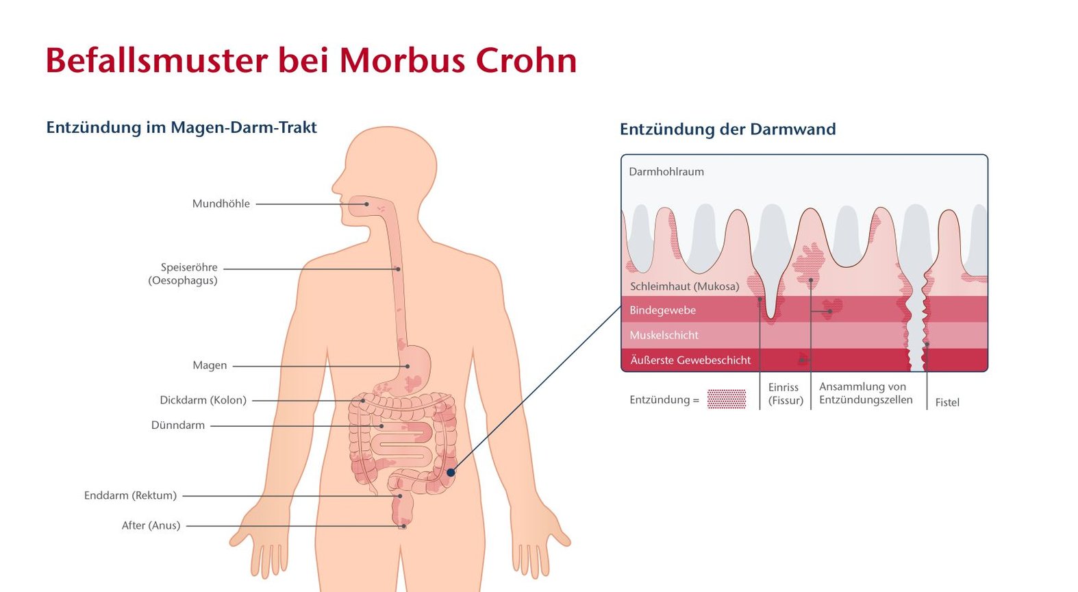 Morbus Crohn, Schema Befallsmuster