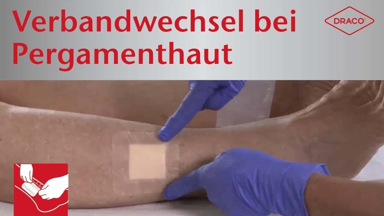 Verbandwechsel bei Pergamenthaut Vorschaubild