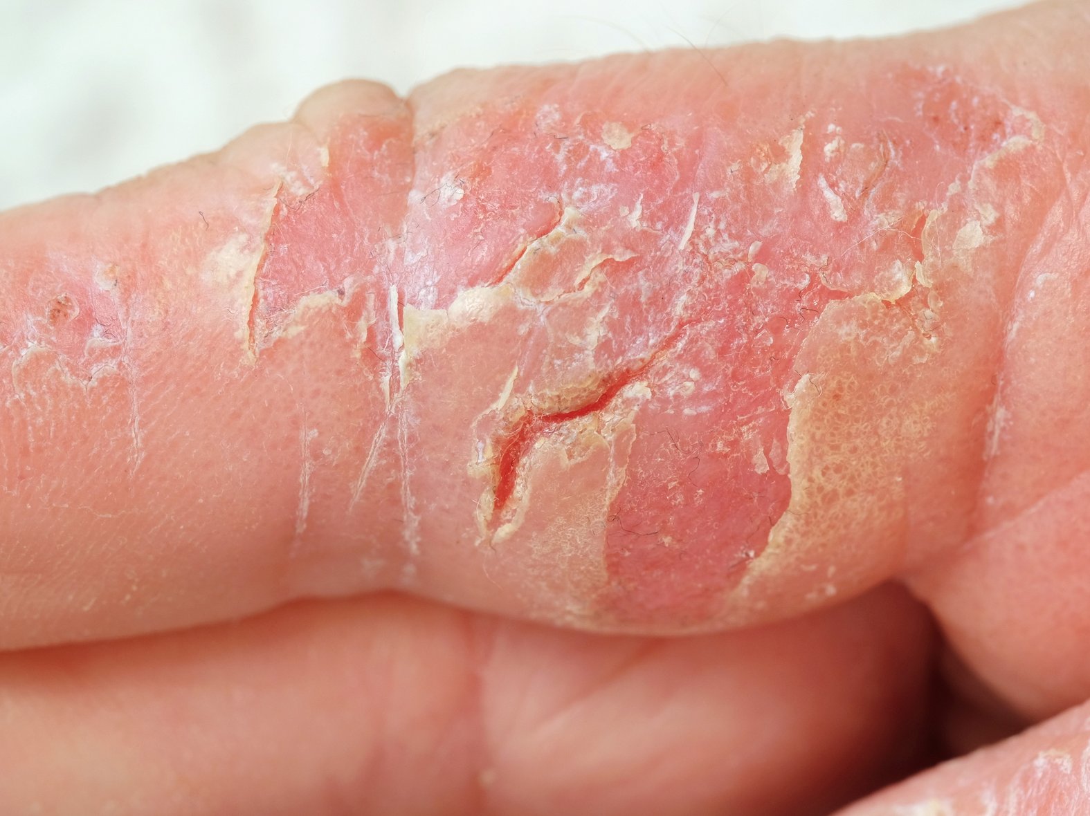 Atopisches Ekzem an der Hand