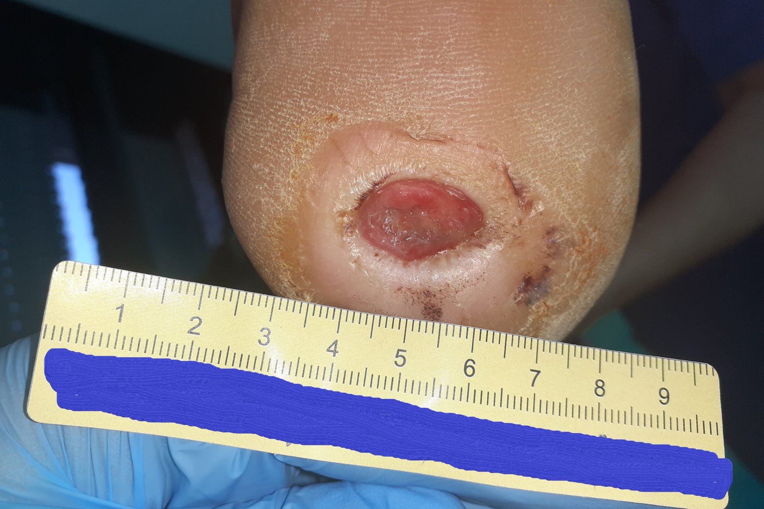 Fallbeispiel Fersenulcus bei Diabetischem Fußsyndrom