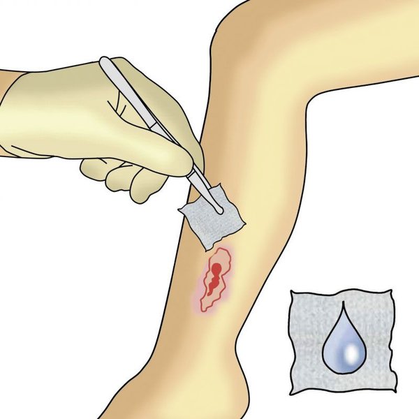 Dracohydroduenn Verbandwechsel Schritt 1