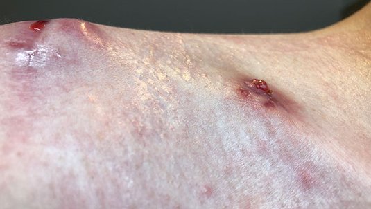 Hypergranulation – Wildes Fleisch auf der Wunde