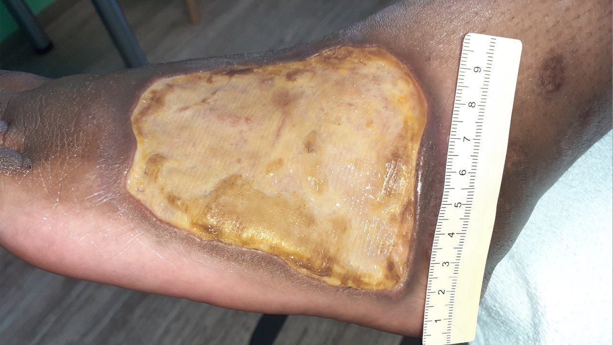 Vaskulitis, Vorher-Bild