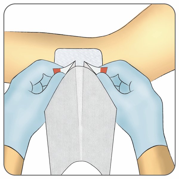 Fixiermull Stretch Anwendung: Ziehen und Ablösen, Schritt 3