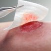 DracoHydrofaser - Hydrofaser-Wundauflage auf einer Wunde