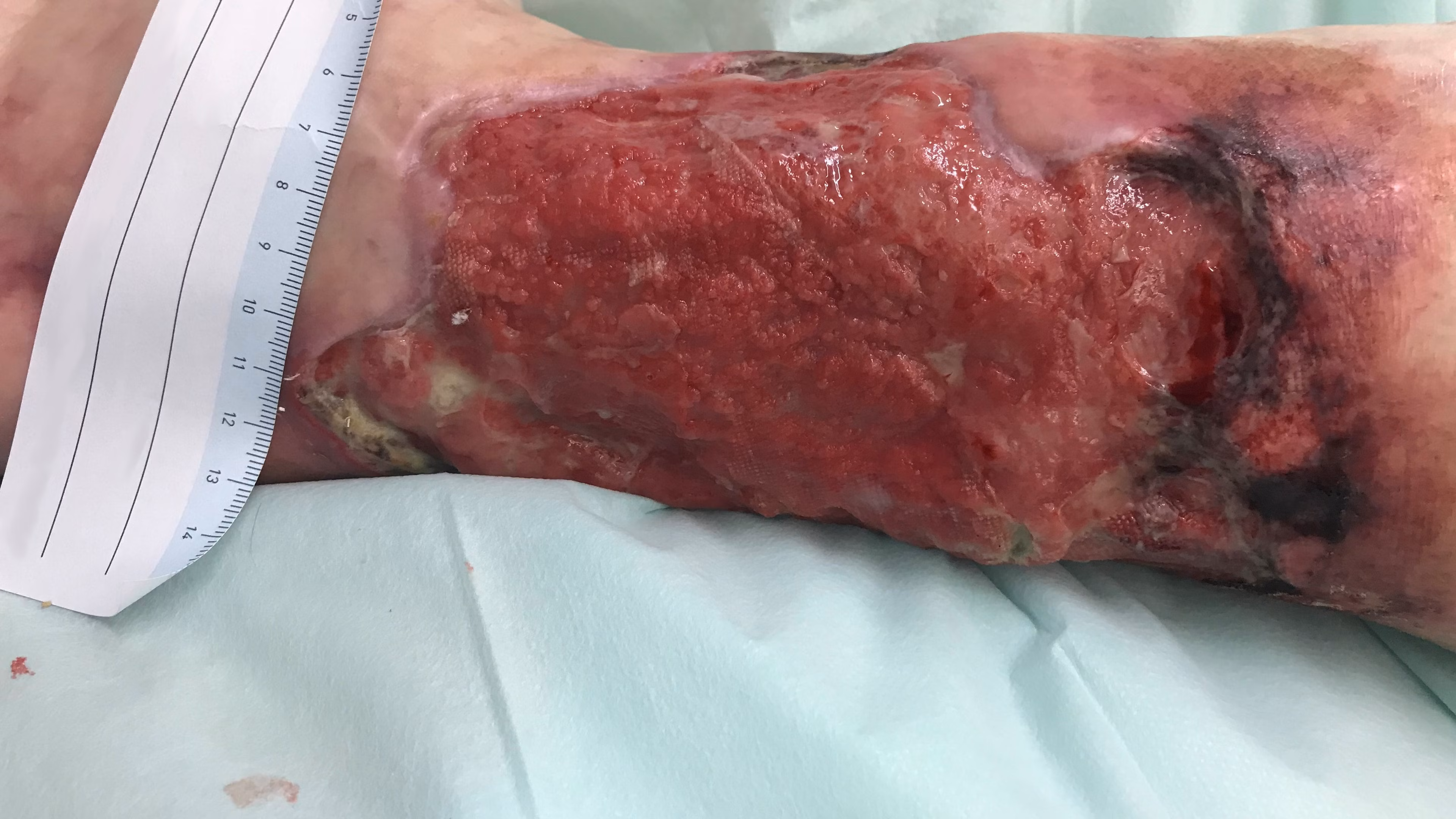 Pyoderma gangraenosum