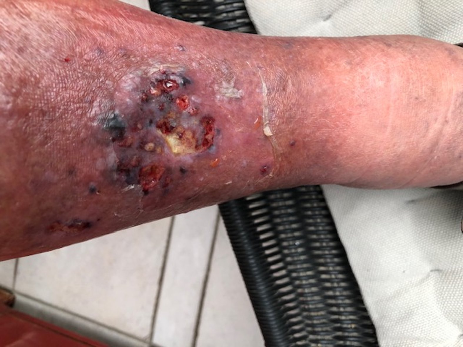 Ulcus am rechten Unterschenkel 1