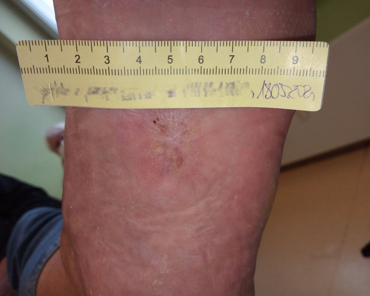 Forschende entwickeln intelligentes Gel für schnellere Wundheilung