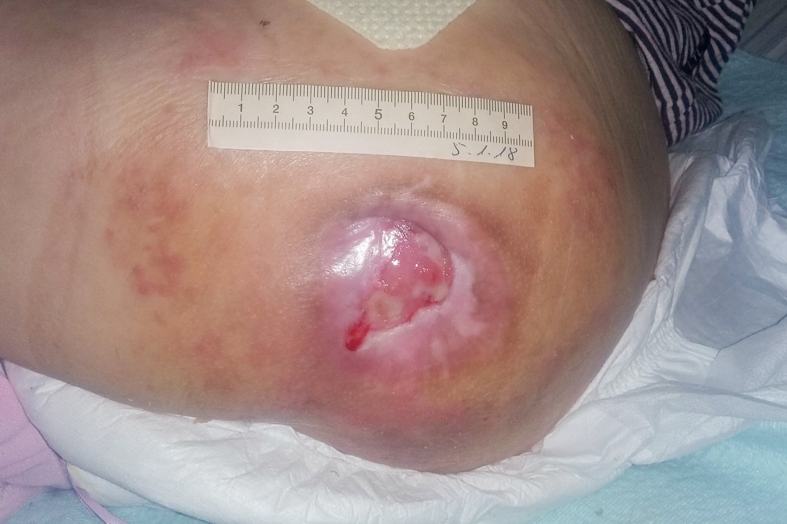 Foto 5: Deutlich verkleinerte Wunde mit voranschreitender Epithelisierung (Tag 225)