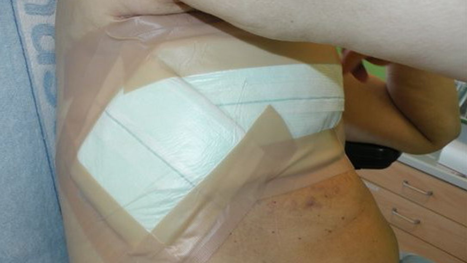 Fallbeispiel Palliative Wundversorgung exulzierender Tumor