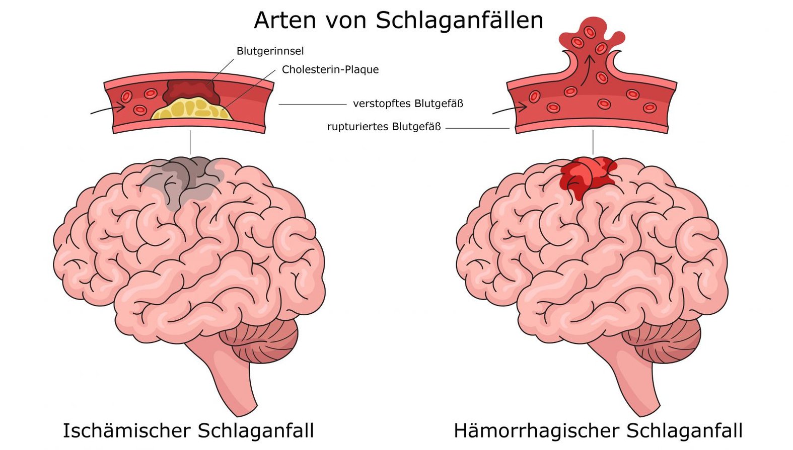 Ischämischer versus hämorrhagischer Schlaganfall