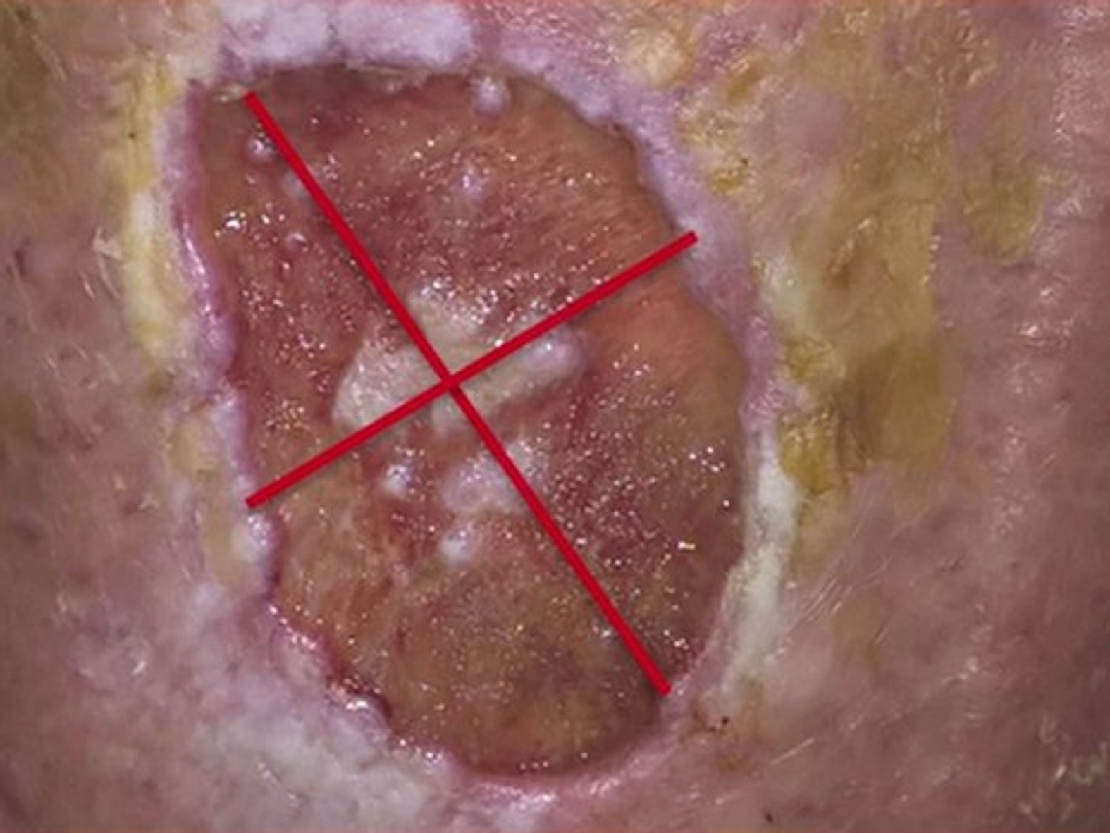 Wundvermessung Länge und Breite nach Maximalwert