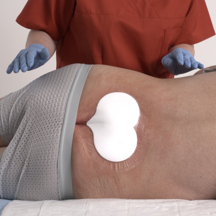 Versorgung eines Sakraldekubitus mit DracoFoam Sakral