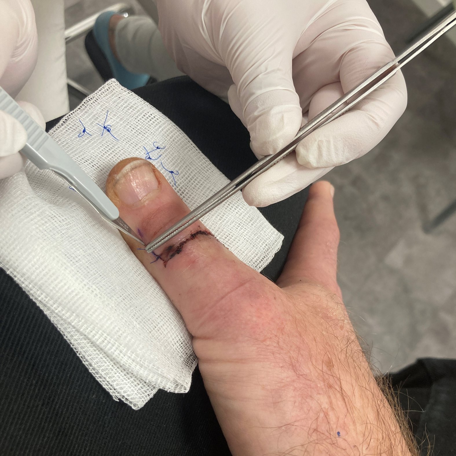 Fallbeispiel Schnittwunde am Daumen