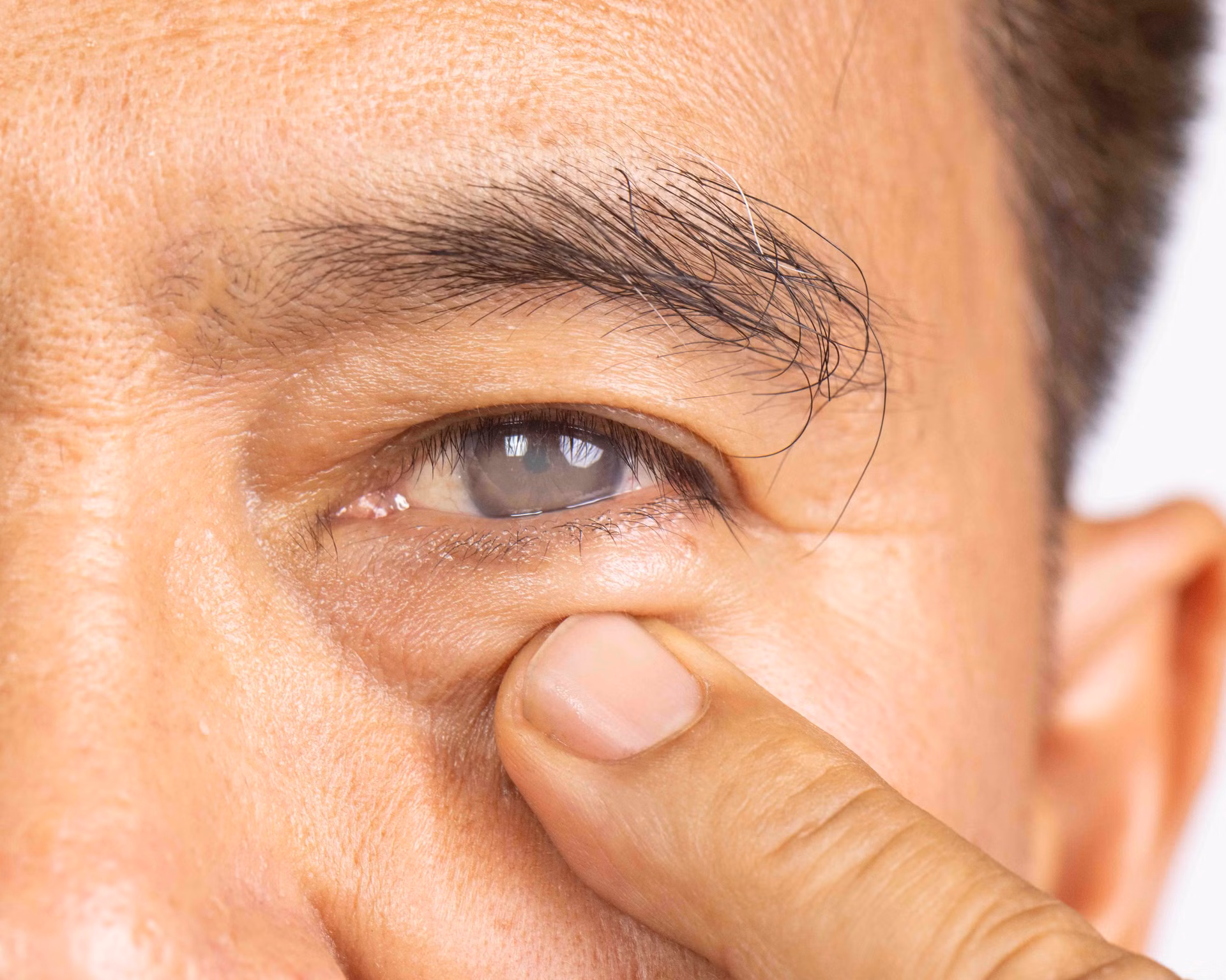 Mann mit grauem Star