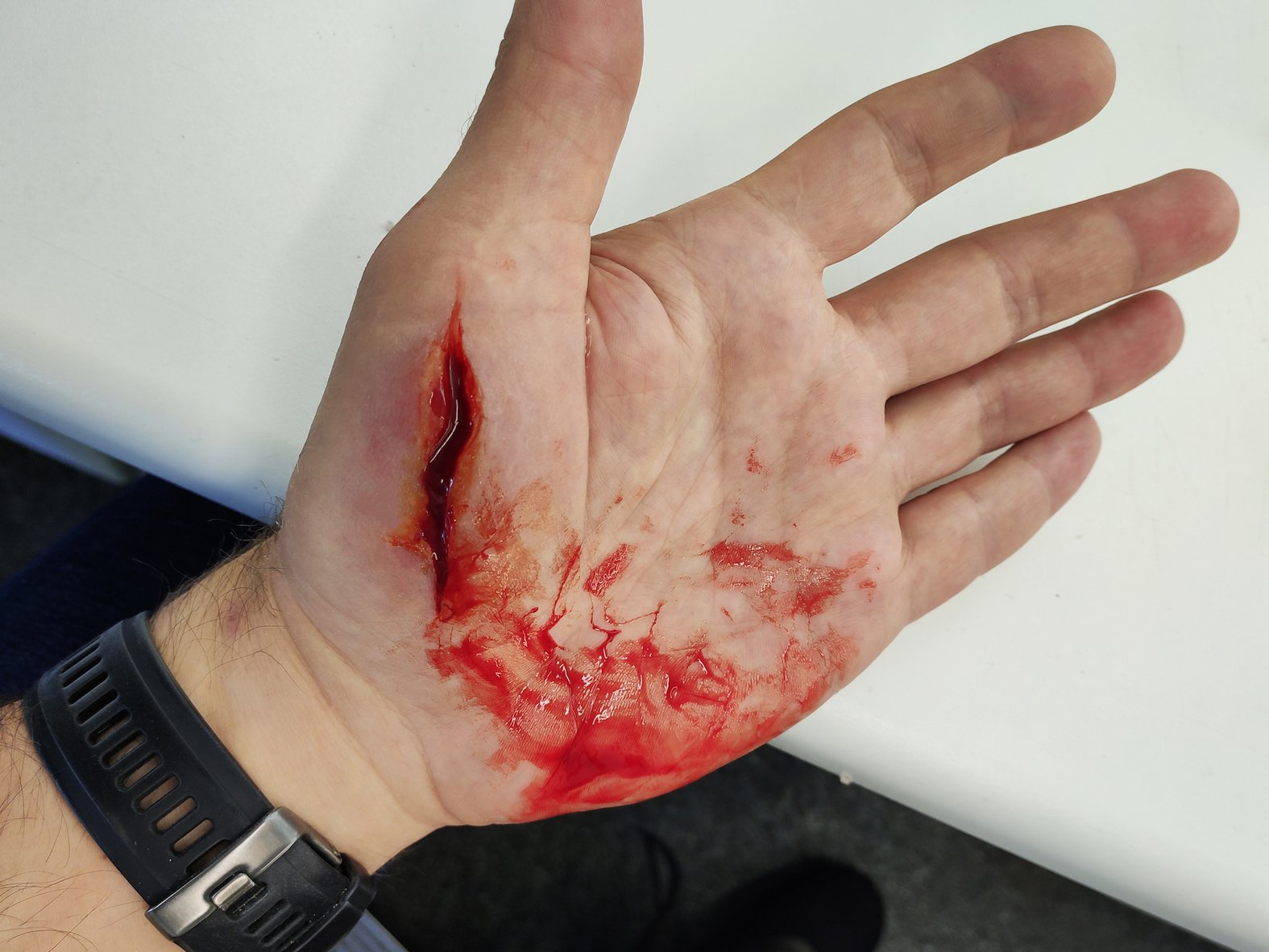 Schnittwunde an der Hand